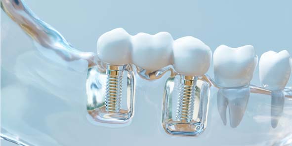 Zahnimplantat: Modell einer Zahnimplantation
