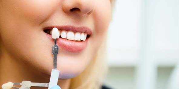 Farbnahme für Implantat-Zahn
